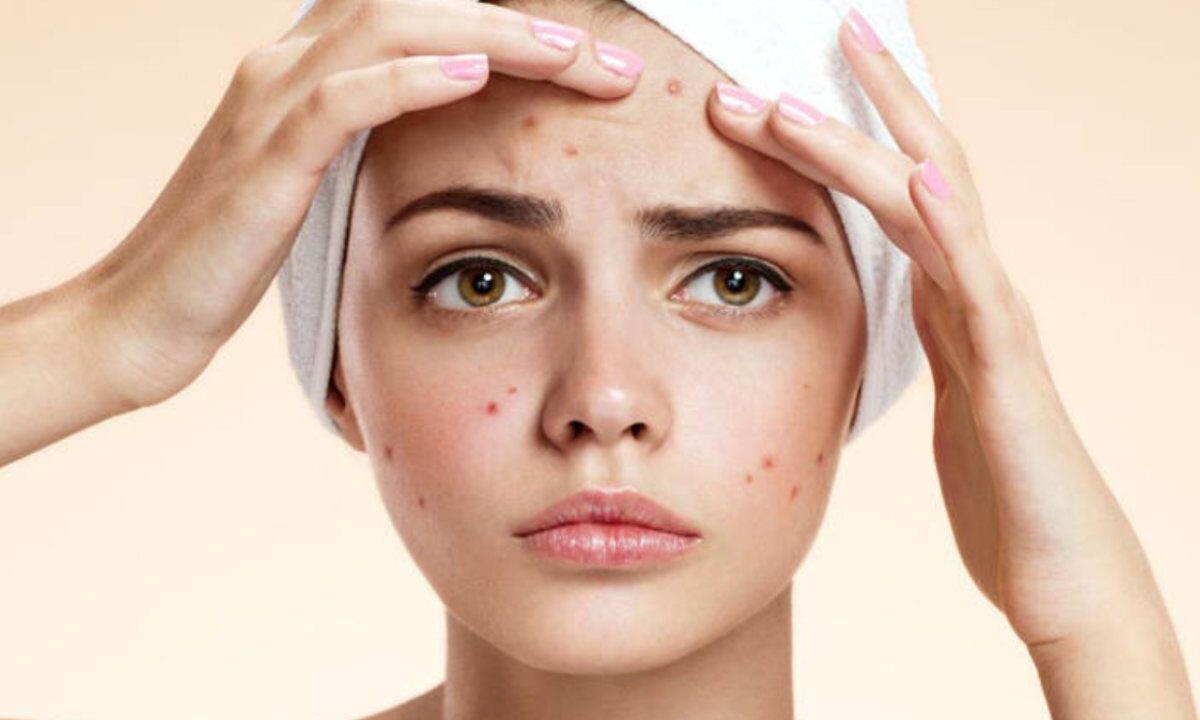 Acne Creams for Oily Skin