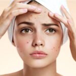 Acne Creams for Oily Skin