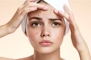 Acne Creams for Oily Skin